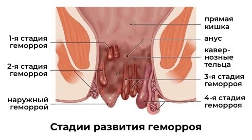 А вот как выглядит проблема анатомически (для тех, кто хочет понять, что там происходит):