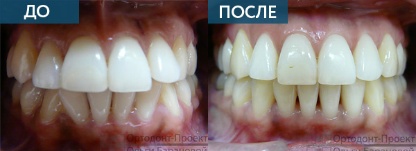 до и после ортодонтического лечения