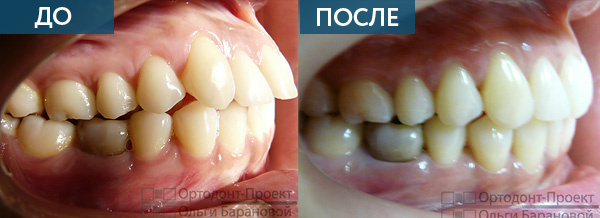 Ортодонтическое лечение прикуса ДО и ПОСЛЕ