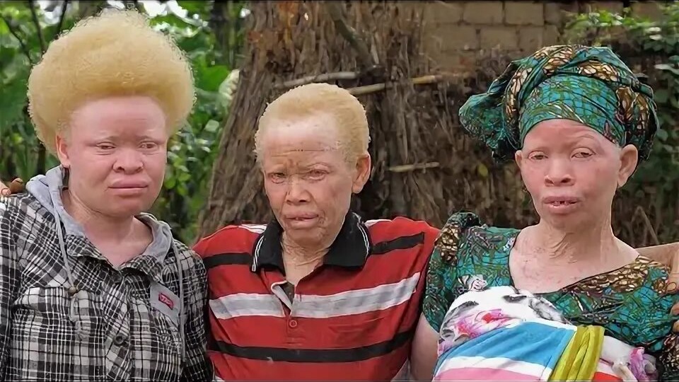 Происхождение альбиносов и их связь с африканским населением: историко-генетический анализ