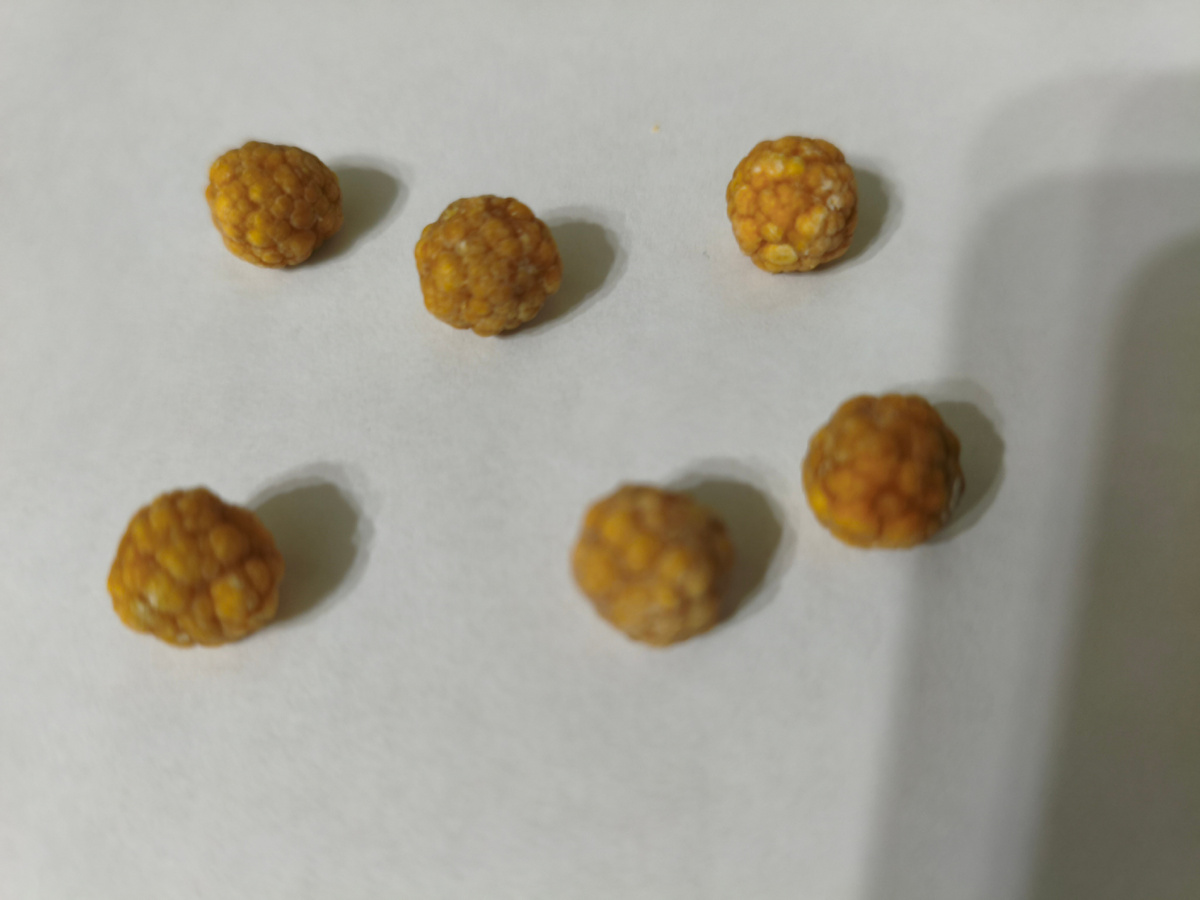 Камни в желчном пузыре.