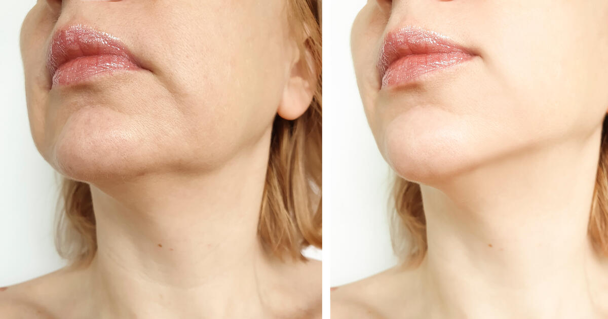 Хронический гипертонус мышц нижней трети лица и шеи усиливает нисходящую тягу тканей и способствует формированию брылей.