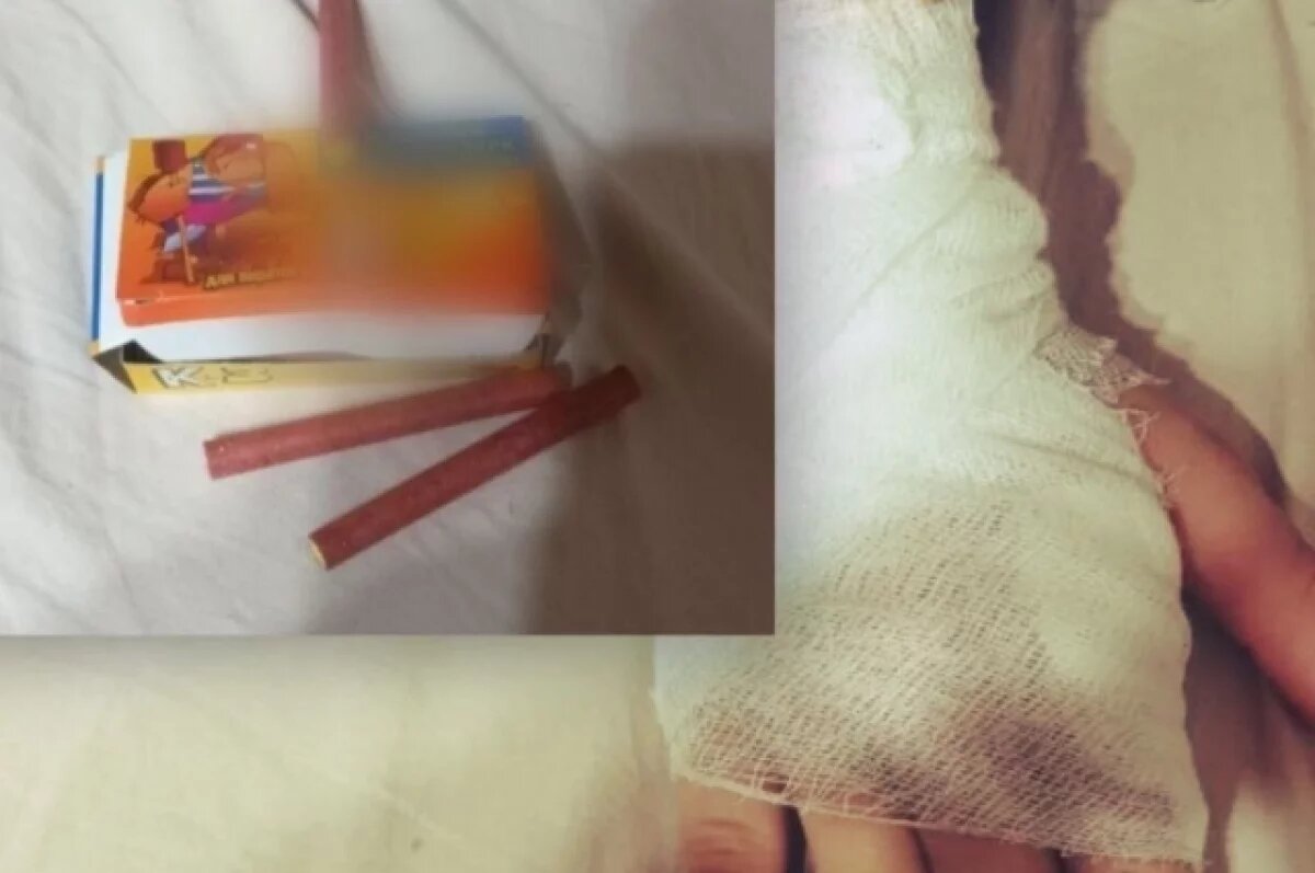    В Удмуртии у ребёнка в руке взорвалась петарда