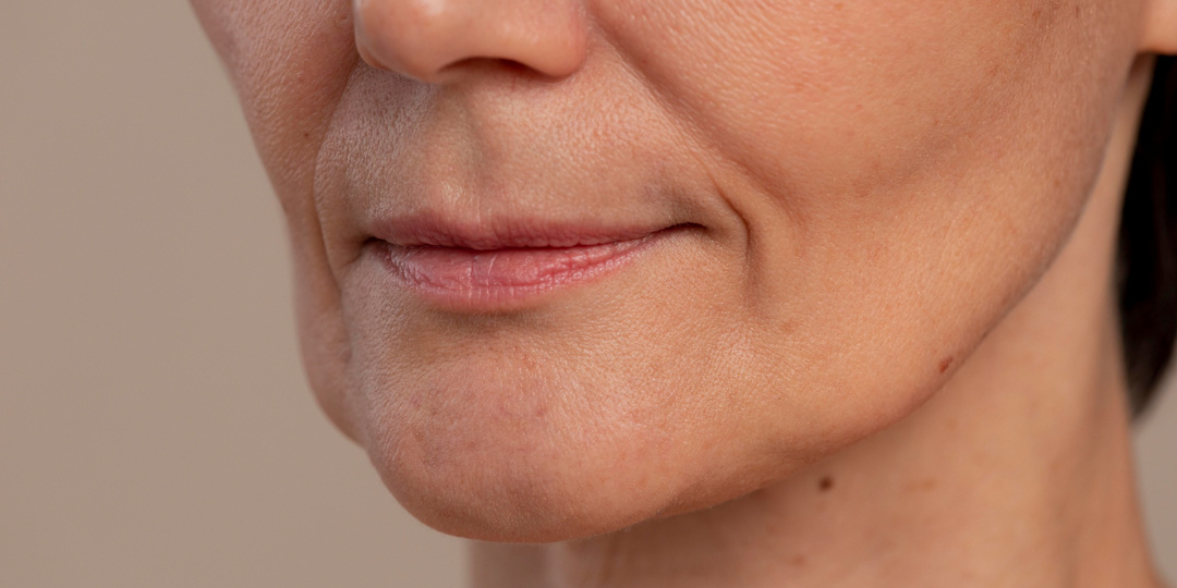 Хирургический вариант: когда без СМАС-лифтинга брыли не уйдут