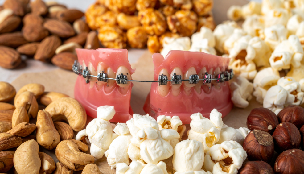 ТОП-3 продукта, которые ломают брекеты чаще всего