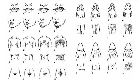 СПКЯ – синдром поликистозных яичников