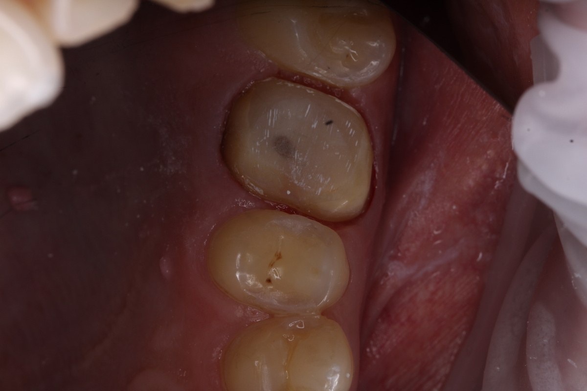 Так выглядит зуб после препарирования: