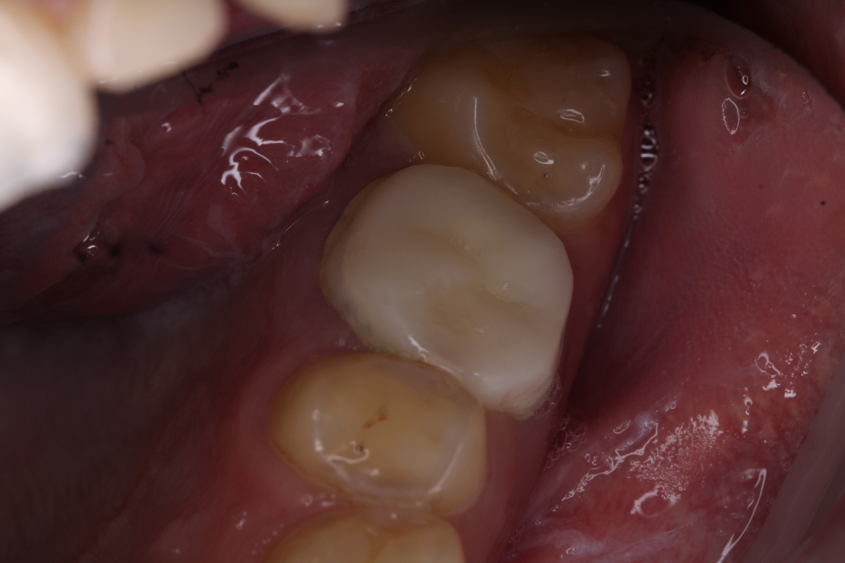 На период изготовления постоянной коронки мы сделали временную пластмассовую.