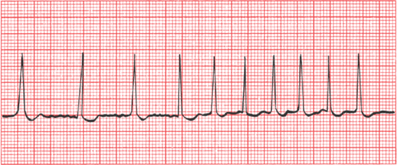 Ритм частый и совершенно хаотичный. "Delirium cordis" бред сердца. Так называют мерцательную аритмию.