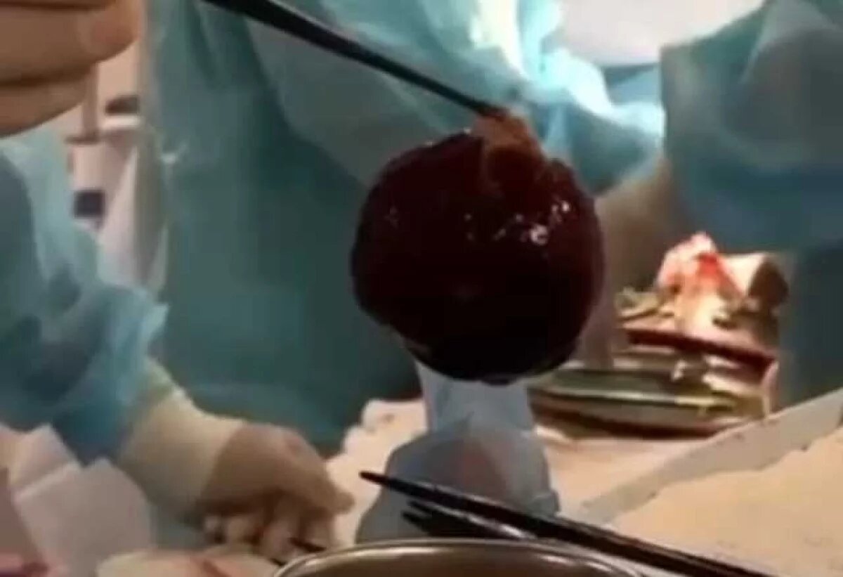    Новообразование стало угрожать жизни Патимат Магомедовой.