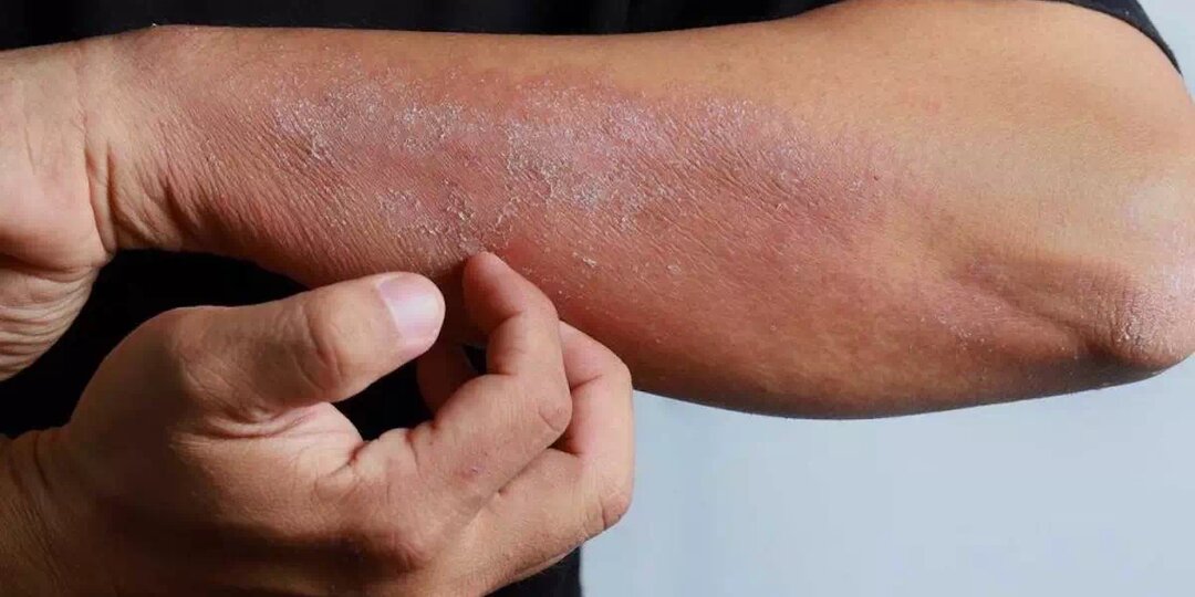 Псориаз без зуда: бывает ли такая форма заболевания