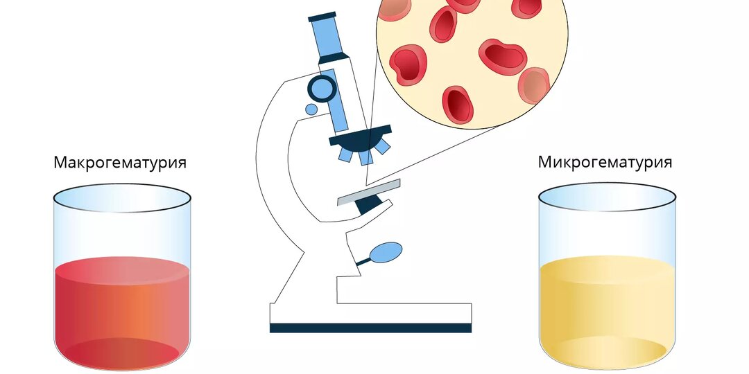 Кровь в моче. Цистит? Что это значит и когда стоит срочно реагировать