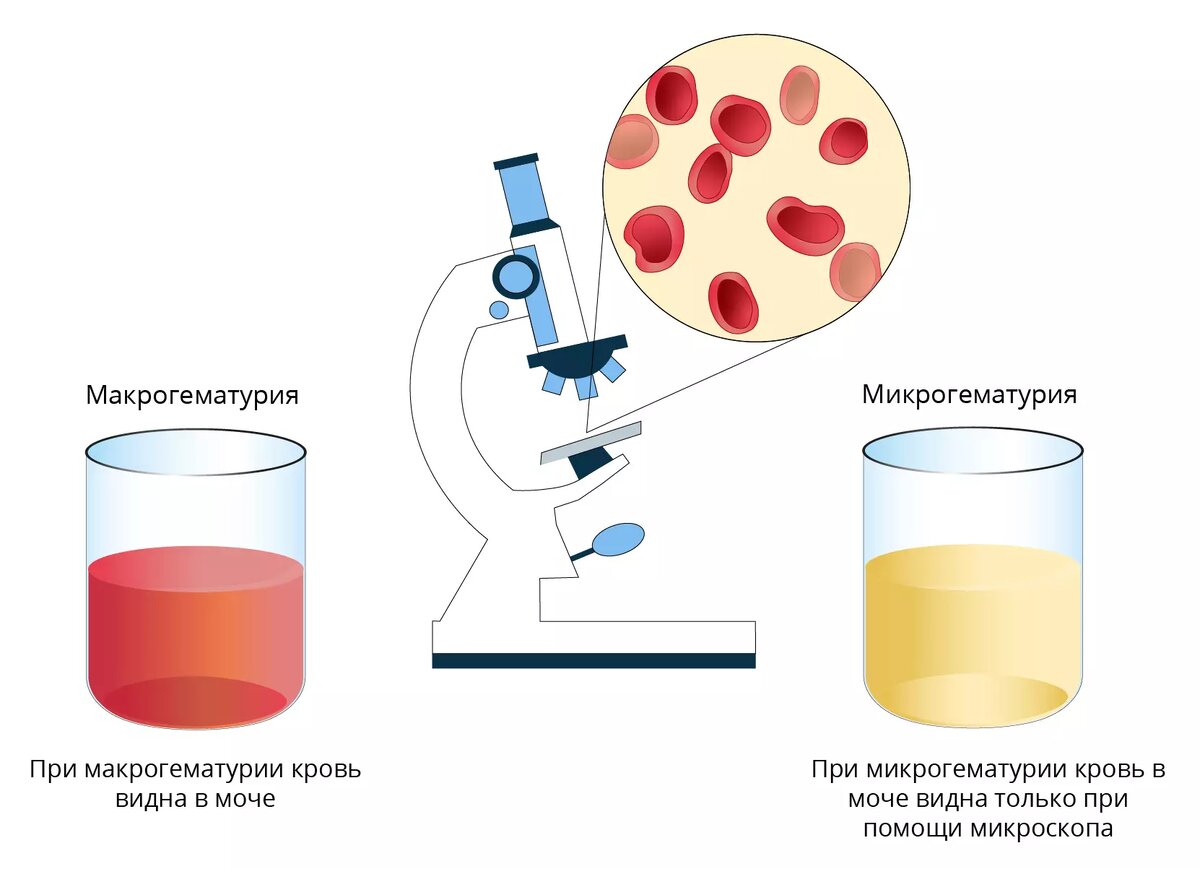 Кровь в моче. Цистит? Что это значит и когда стоит срочно реагировать