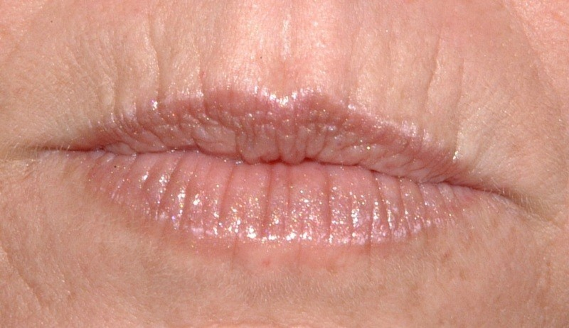 Кисетные морщины над верхней губой: почему появляются и как убрать морщины вокруг губ