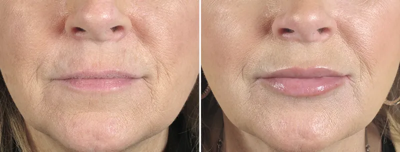 Кисетные морщины — это вертикальные линии над верхней губой, возникающие из-за мимики, снижения качества кожи и активности круговой мышцы рта.