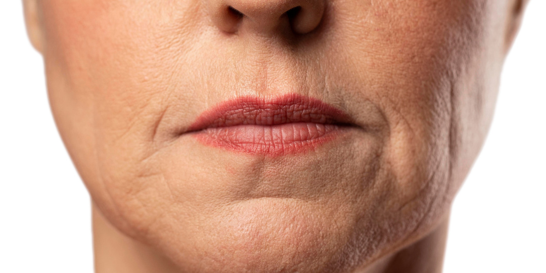 Основные причины появления морщин над верхней губой