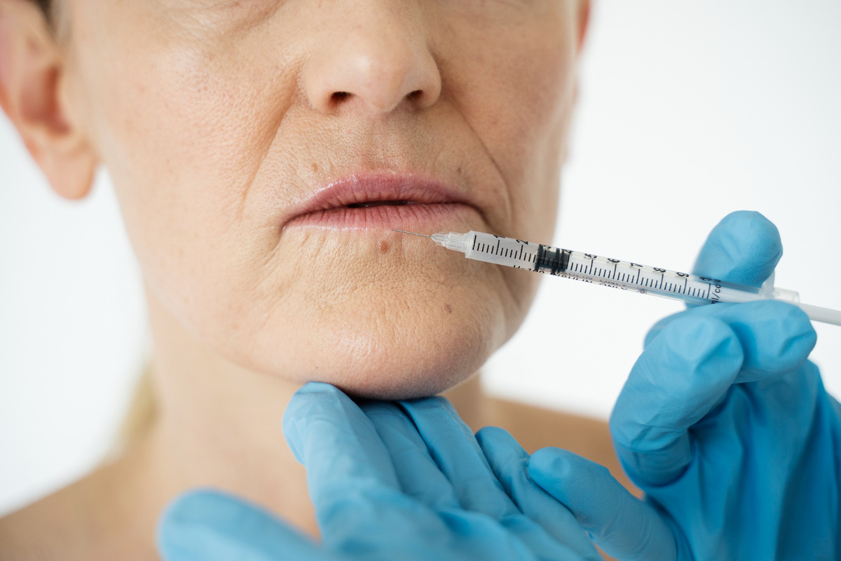 Ботулинотерапия в зоне губ мягко снижает мимическое перенапряжение круговой мышцы рта, но требует высокой точности, чтобы избежать нарушения мимики и артикуляции