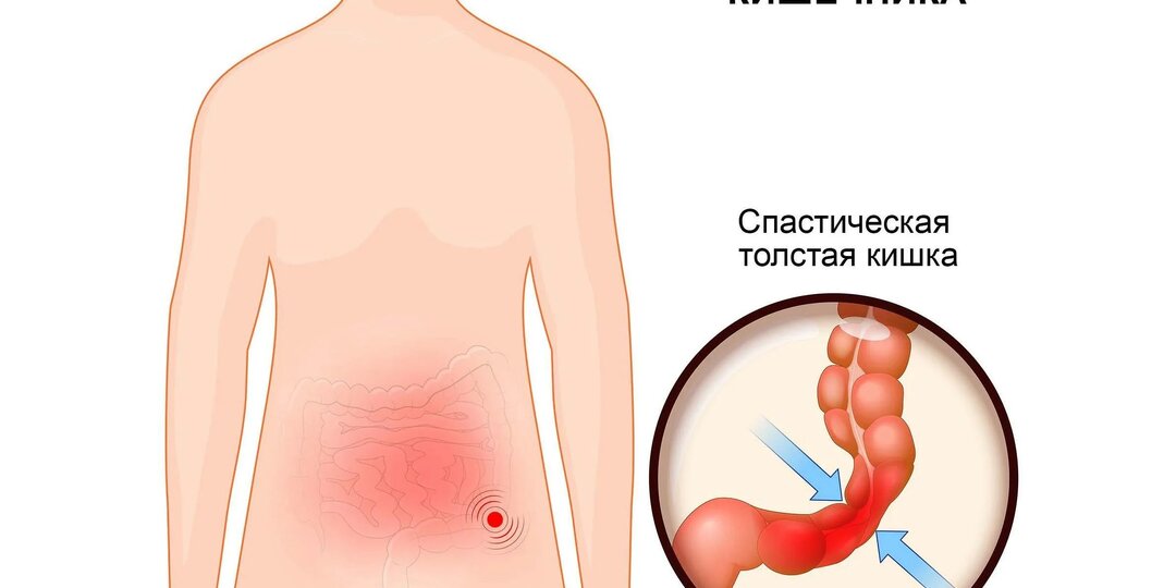«Живот урчит, а анализы — в порядке»: как распознать синдром раздражённого кишечника и начать жить без страха перед каждым приёмом пищи