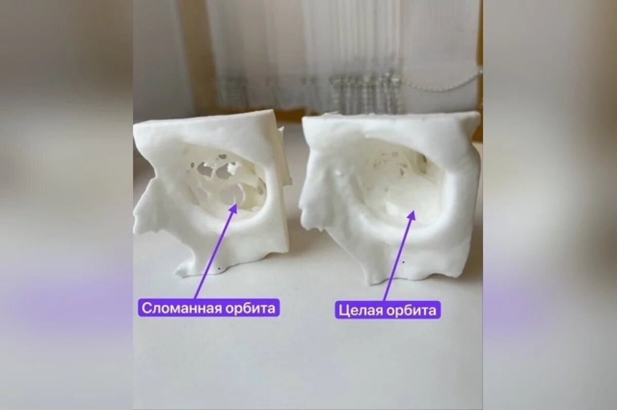    В РКБ Татарстана хирурги восстановили пациенту орбиту глаза из хряща ребра