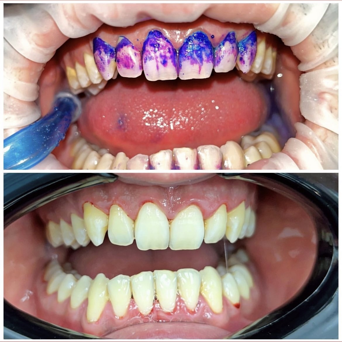 Фото до и после проведения профессиональной гигиены полости рта