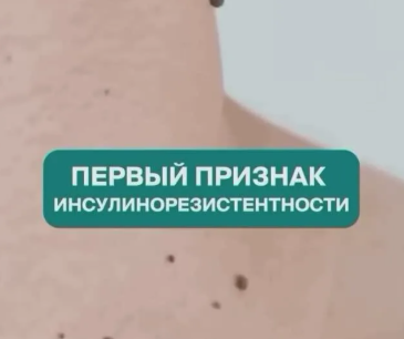 Первый признак - появление папиллом