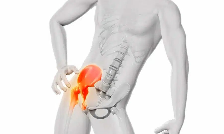 Правда о коксартрозе тазобедренного сустава и что с этим делать