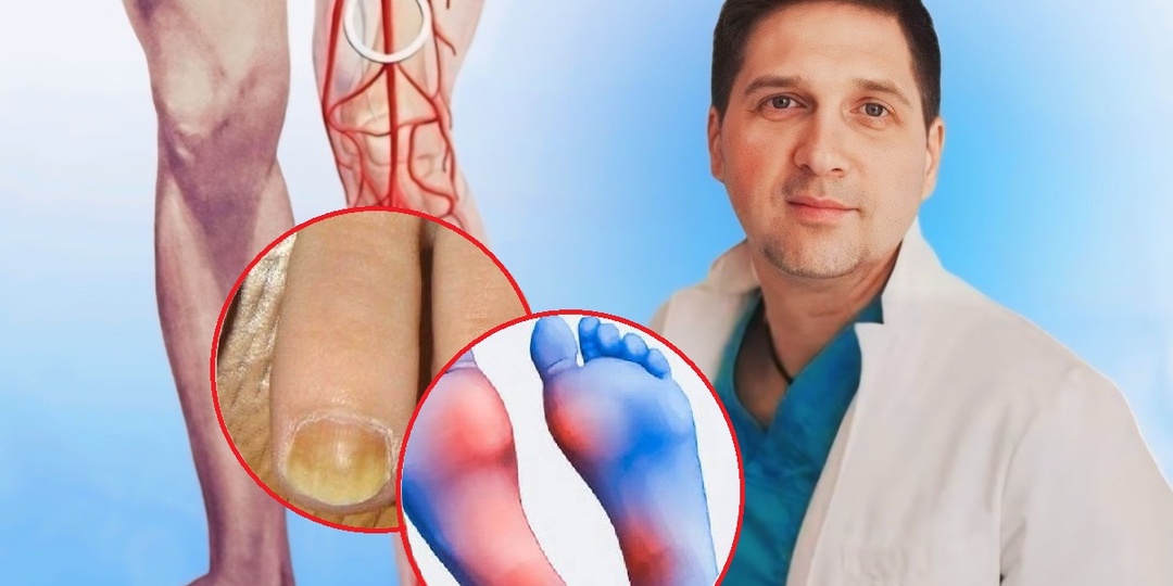 Как понять, что забиты сосуды ног: 8 ранних признаков, которые нельзя игнорировать