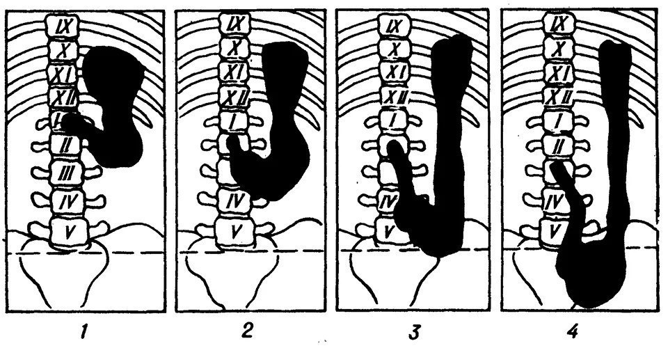 Рефлюкс, изжога, заброс желчи (ГЭРБ, ДГР