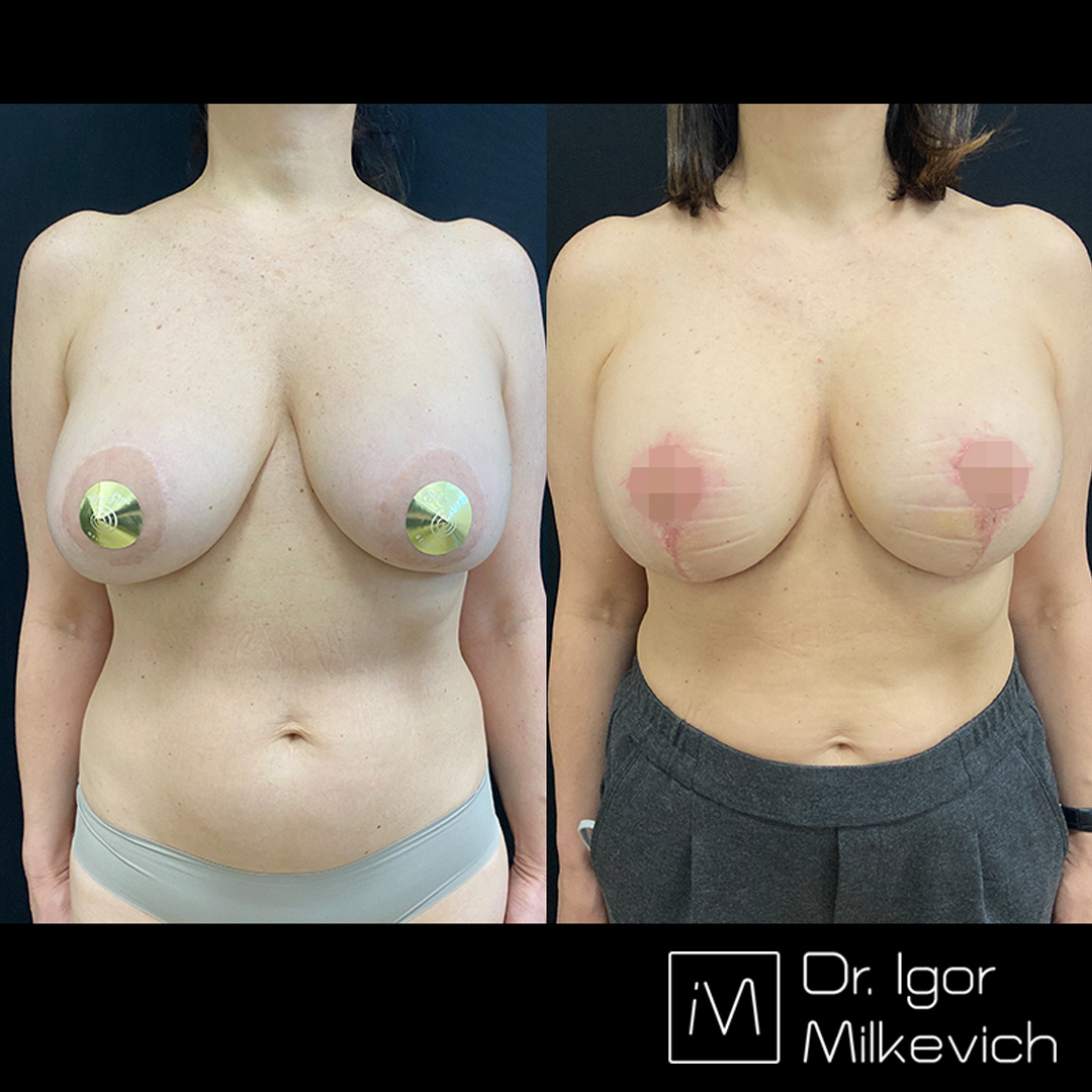 Ранний результат после повторной маммопластики. Ранее была проведена подтяжка по ареоле. Обратите внимание на растянутые ареолы. Полностью удалить старую ареолу не удалось, частично она оказалась в районе вертикального рубца. 