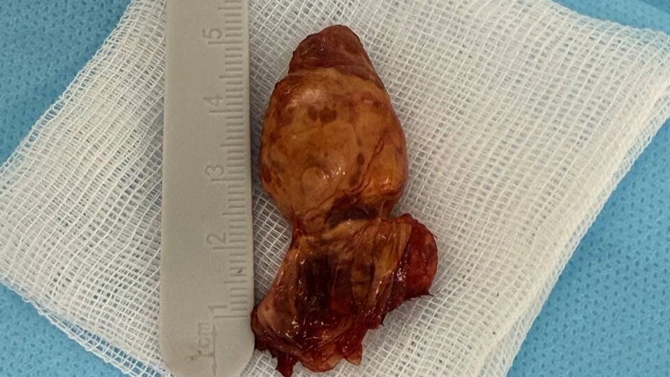 Обширную опухоль кисти удалили у ребенка липецкие врачи