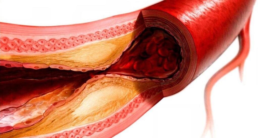 Не холестерин виноват? Ученые нашли скрытого дирижера бляшек в наших сосудах. И это меняет все