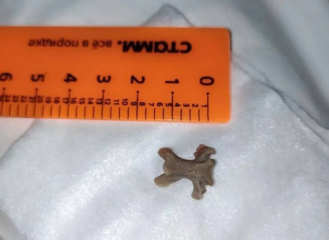    Врачи Советской районной больницы спасли югорчанина с косточкой рябчика в бронхе