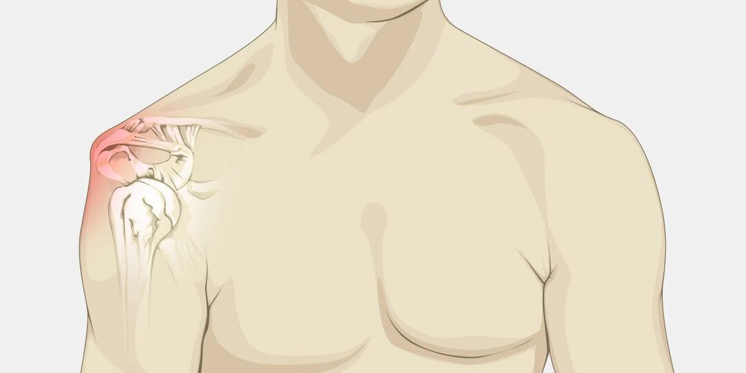 Почему болят плечи: основные причины, о которых нужно знать