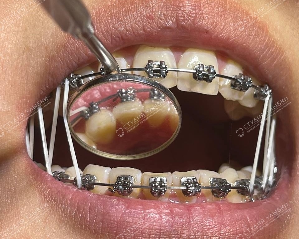 Почему исправление прикуса у одних занимает год, а у других — три: 5 ключевых факторов