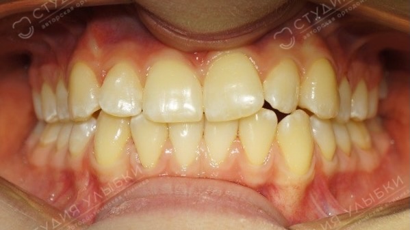 [ФОТО: ДО ЛЕЧЕНИЯ] 15 лет, небольшая скученность зубов, физиологичный прикус