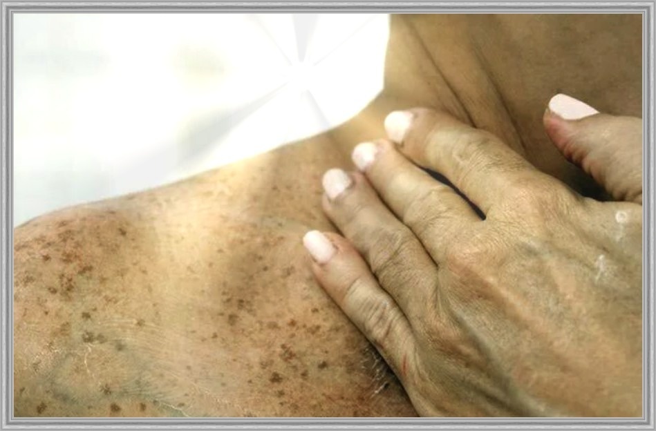 Многие удивляются - я же не загораю. Но городское солнце работает даже через облака и стекла. Прогулки, поездки за рулем, редкий SPF по праздникам - и результат на лице.
