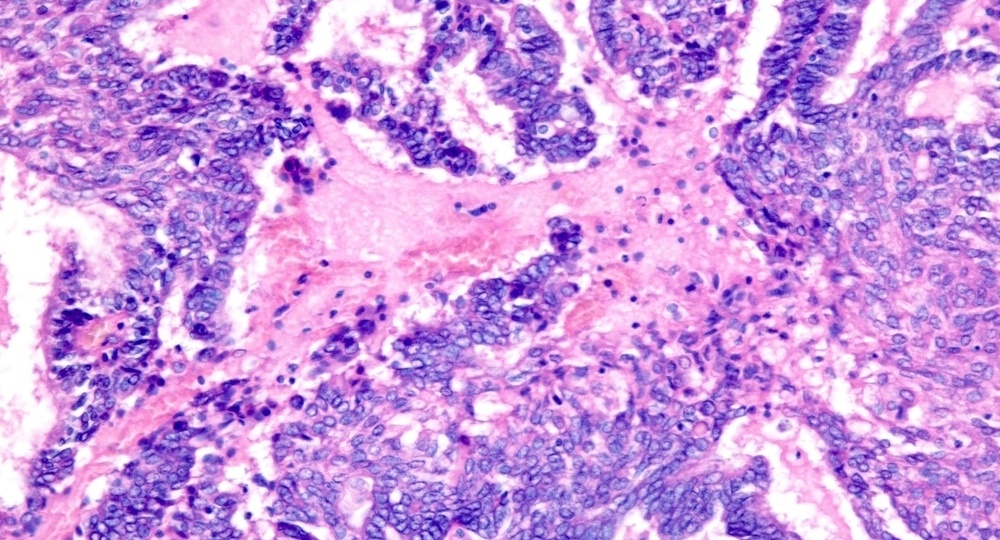 Метод очищения крови впервые испытан в качестве вакцины от рака