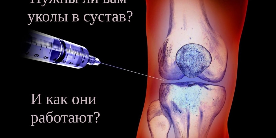 Нужны ли вам уколы в сустав?