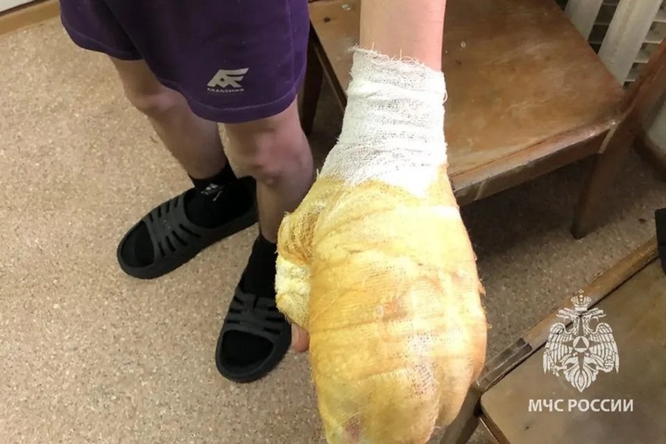    Пострадали из-за пиротехники. Фото: МЧС России