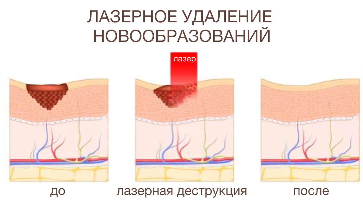 Как проводится удаление новообразований лазером