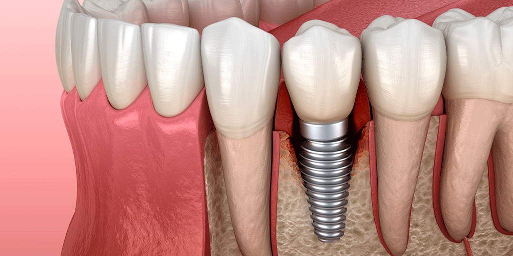 Воспаление вокруг импланта (периимплантит)