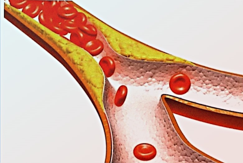 Естественные способы снижения холестерина