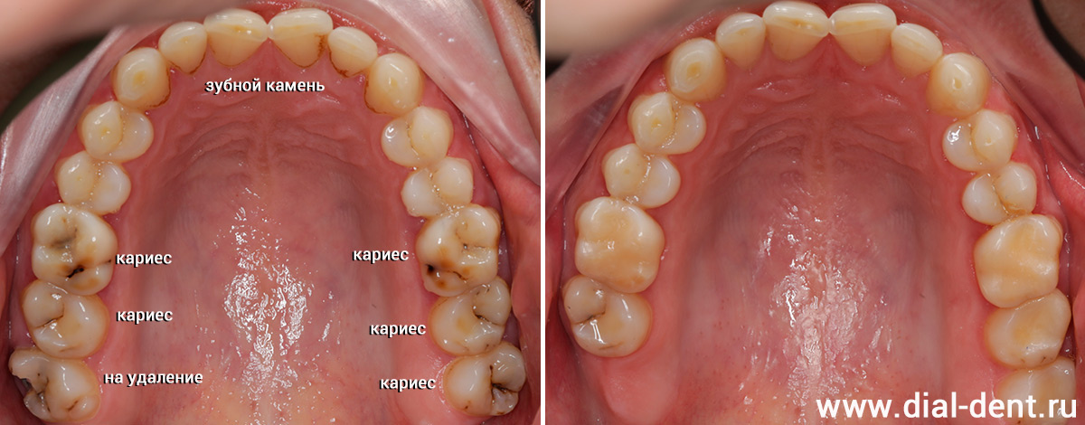 гигиена, лечение кариеса, удаление зуба мудрости