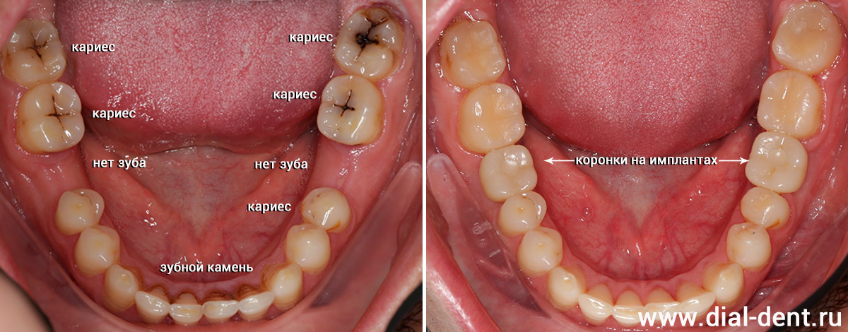 гигиена, лечение кариеса, имплантация, протезирование зубов на имплантах