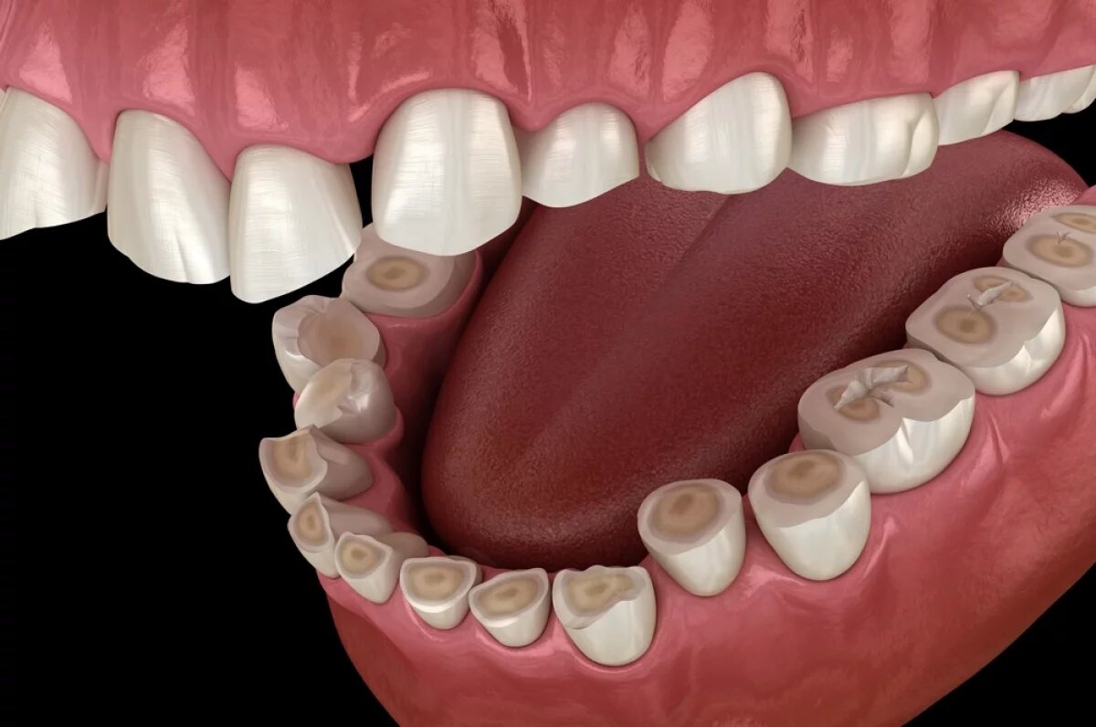    Основная опасность бруксизма — в колоссальной силе, которая в десятки раз превышает жевательную нагрузку.