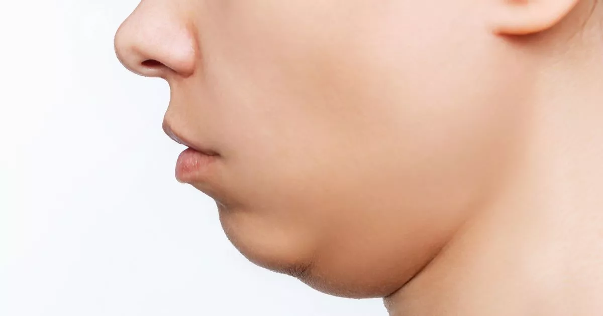 Почему у меня второй подбородок и что делать?