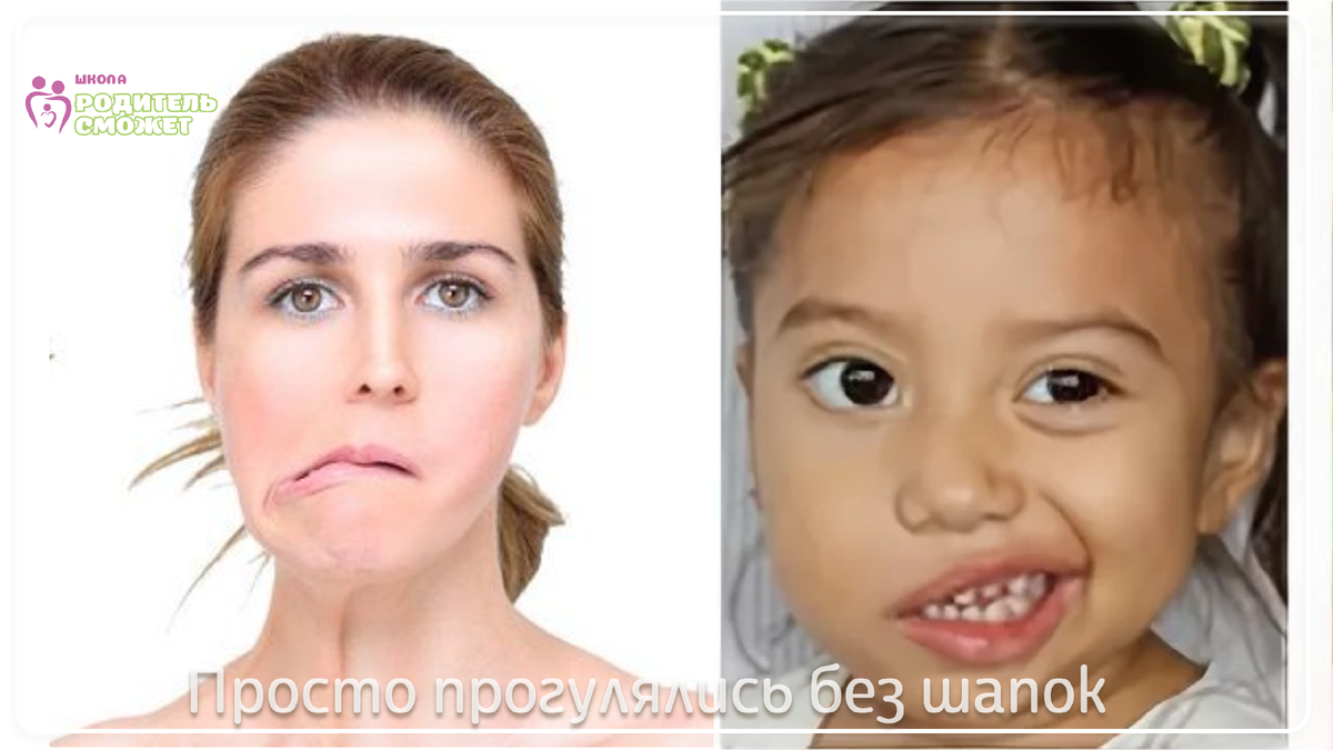 ФОТО лиц людей, страдающих поражением лицевого нерва взяты из открытого источника "Яндекс-картинки"