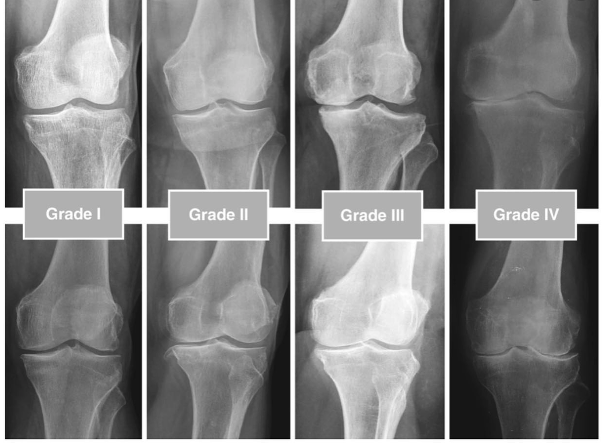 стадии артроза по Kellgren-Lawrence
