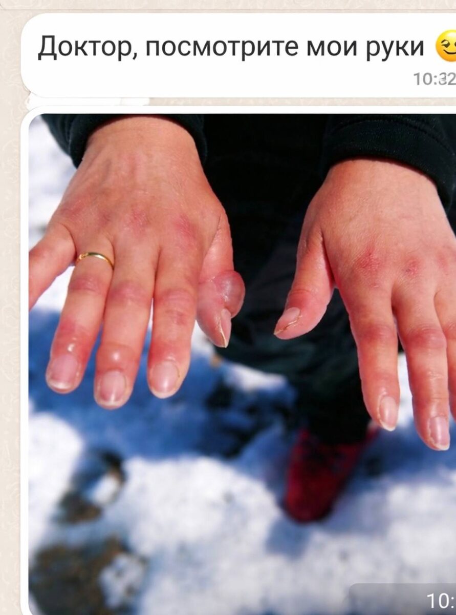 Телефонный звонок 2 января… 
Мне генетически передался страх звонков ночью или в праздничные дни. В моем детстве вся семья вздрагивала от ночных звонков.
Дедушка работал на подстанции. Если был звонок, это означало, что кто-то умер.
Бабушка в больнице. Если звонили, значит, кому-то было очень плохо.
Каждый Новый год или перед ним мне тоже кто-то звонит, и я всегда автоматически беру трубку. В этом году до Нового года обошлось. Пальцы никто не ломал и в блендер не засовывал.

🔔Но утром сегодня был звонок от пациентки.
Из ее рассказа…
🎄Она решила отпраздновать Новый год у сестры под Самарой, в деревне. От города до деревни далеко. Привез их сосед и уехал.
После боя курантов решили пройтись по улице, подышать свежим воздухом.

💨Ветер, которого я не заметила сначала, начал обжигать лицо. Через час кожа горела, как после ожога, губы покрылись трещинами и кровоточили. Каждая мимика причиняла боль.

🛒Мы заскочили в магазин согреться. И тут я почувствовала: на руках, согревшихся в тепле, вздулись красные волдыри и начался адский зуд. Холодовая крапивница. Руки горели изнутри, хотелось содрать кожу.

🦌Обратная дорога стала кошмаром. Ветер крепчал, а я, оглушенная зудом, слишком поздно поняла, что пальцы в легких перчатках онемели. Дома сняла ботинок и застыла: пальцы ног были белыми, как воск, неживыми. Обморожение.

🔥Теперь сижу, закутавшись в плед. Лицо пылает, руки чешутся, а пальцы ног пульсируют тупой болью.

☎️Все, что я могла по телефону, – это рассказать, что можно делать в такой ситуации, а что лучше не надо. Сейчас пациентка уже в больнице, и ей оказывают помощь.
Будьте аккуратны в зимнее время. Выбирайте правильную одежду, не гуляйте долго, мажьте перед выходом лицо кремом, чтобы избежать проблем.

✔️Если хотите получить краткую инструкцию по первым признакам обморожения лица и конечностей ставьте плюсик + и я вам пришлю