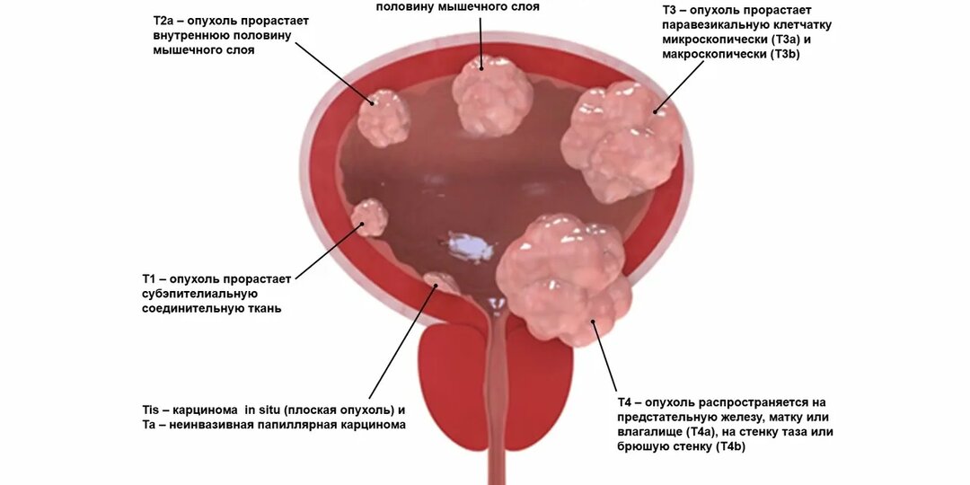 Рак мочевого пузыря